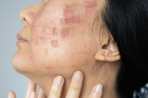 Leke Tedavisi Amaçlı Cilt Uygulamaları